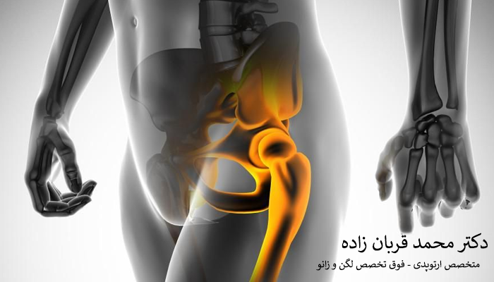 افرادی که نیاز به تعویض مفصل لگن دارند