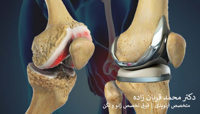 جراحی تعویض کامل مفصل زانو