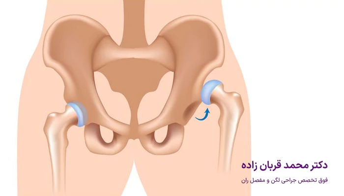 چه عواملی در نتایج جراحی تعویض مفصل لگن موثر هستند؟