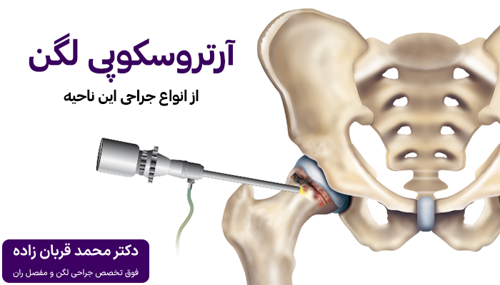 آرتروسکوپی لگن از انواع روش های جراحی لگن