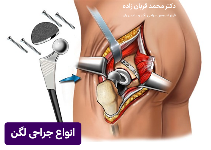 انواع جراحی لگن در مازندران