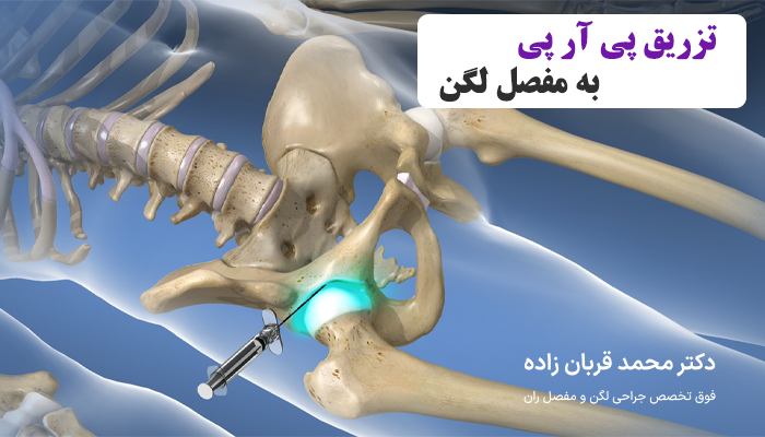 تزریق پی آر پی به مفصل لگن برای درمان