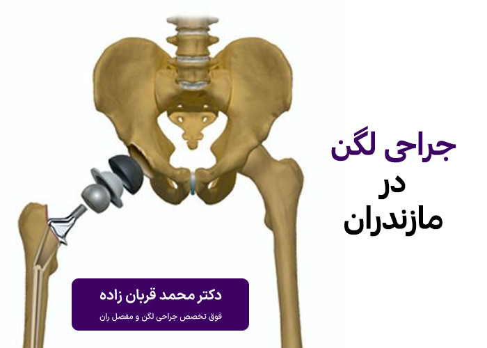 جراحی لگن در مازندران چگونه است