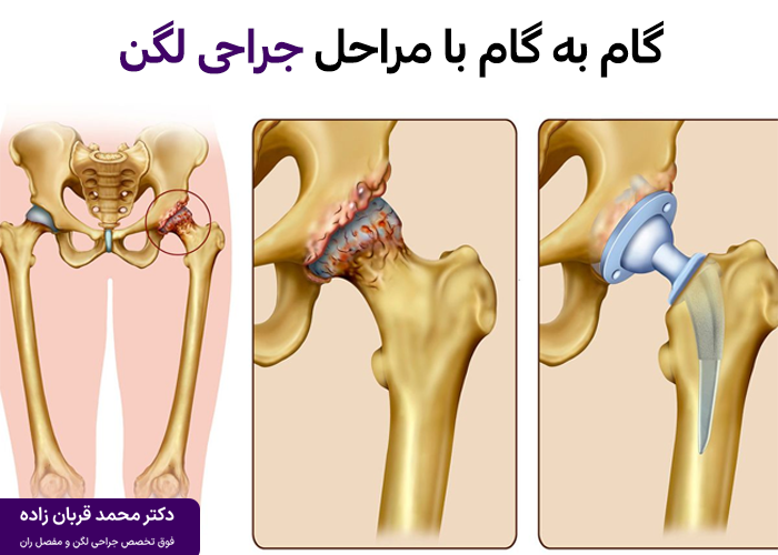 مراحل جراحی لگن