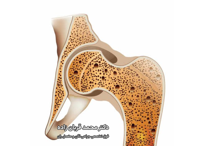 پوکی استخوان از عوامل مشکلات لگن