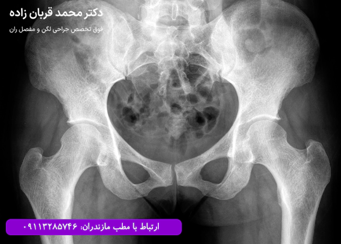 تصویربرداری از لگن قبل از آرتروسکوپی آن