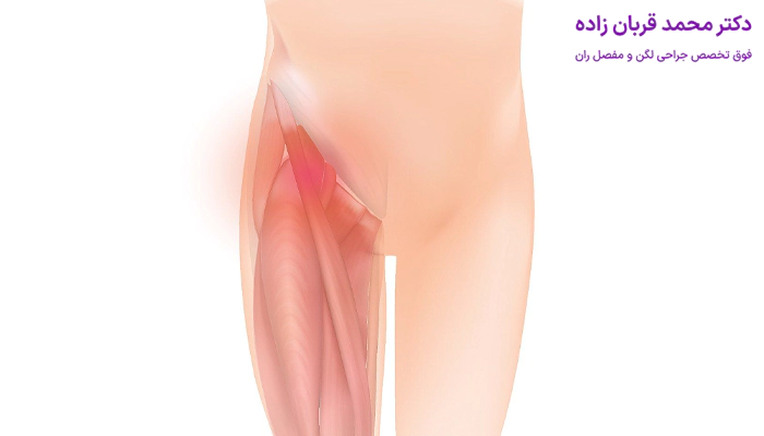 آرتروز لگن باعث ایجاد درد در کدام قسمت ها میشود؟