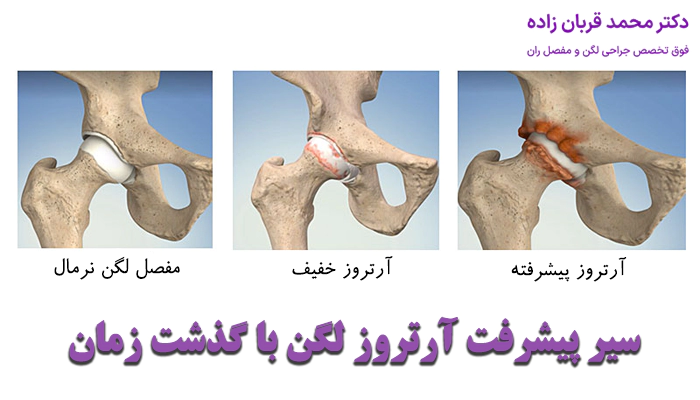 پیشرفت آرتروز لگن چگونه است؟