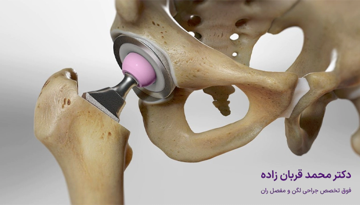 چرا باید حتما بهترین جراح لگن را انتخاب کنیم؟