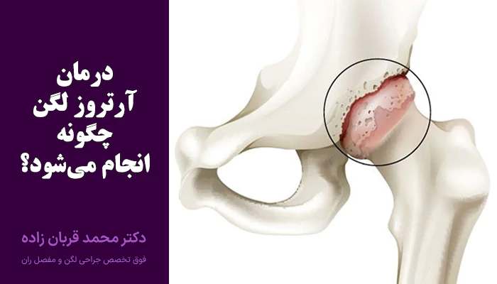 درمان آرتروز لگن چگونه انجام میشود؟