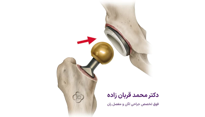 دلایل مختلفی که باعث درد بعد از تعویض مفصل لگن میشوند