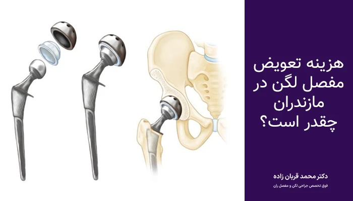 قیمت عمل تعویض مفصل لگن در مازندران
