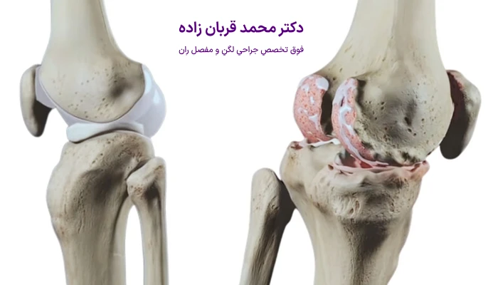 روش های تشخیص آرتروز زانو