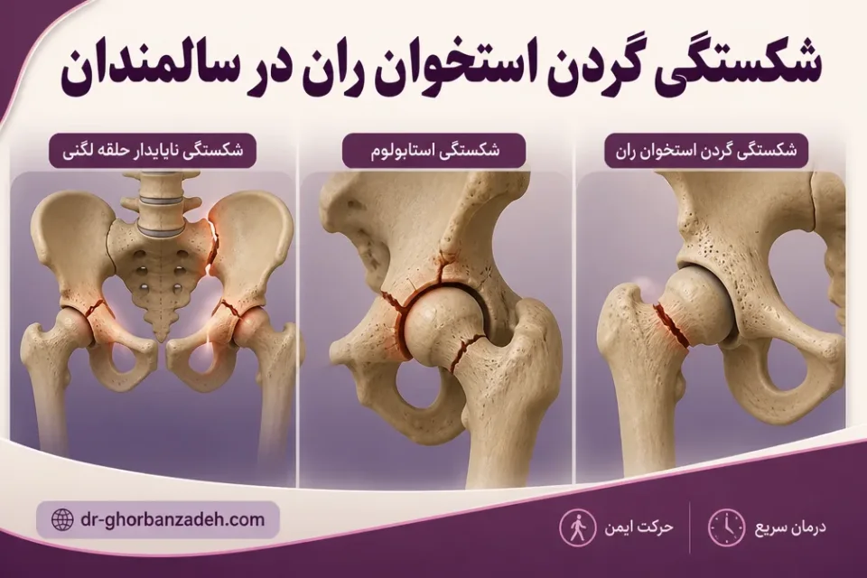 شکستگی گردن استخوان ران در سالمندان — مقایسه محل شکستگی ناپایدار لگن، استابولوم و گردن استخوان ران