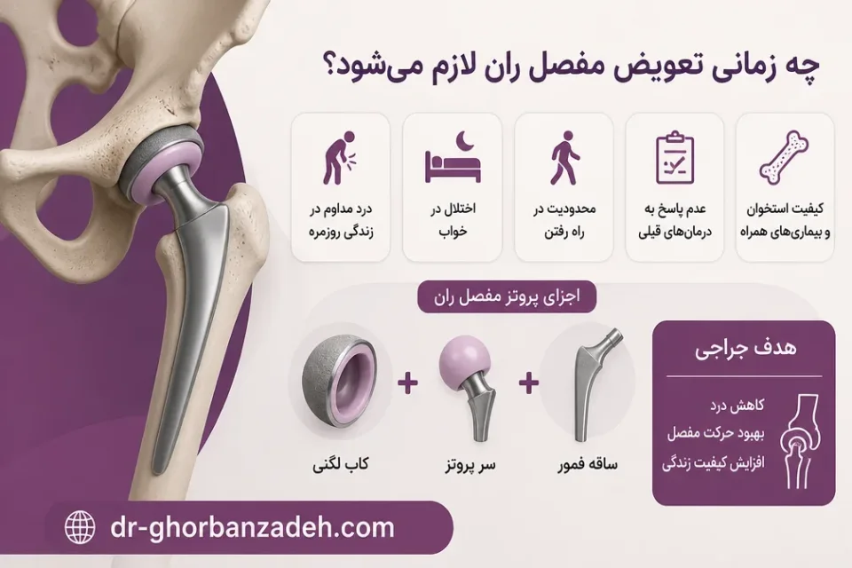 چه زمانی تعویض مفصل ران لازم میشود — نمای آموزشی اجزای پروتز در تعویض مفصل ران برای درمان تخریب سر استخوان ران