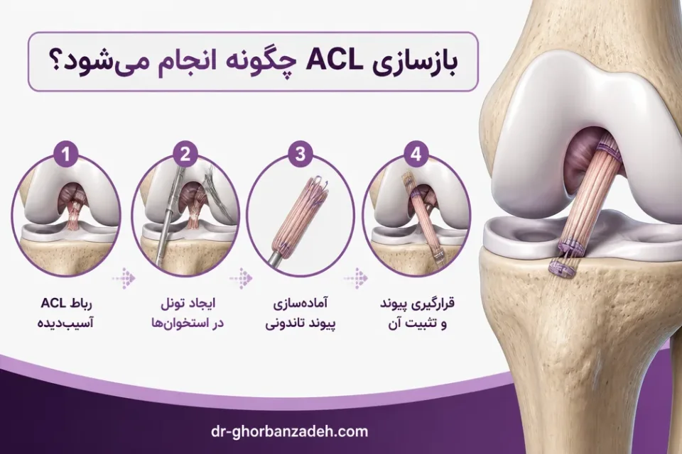 نمای توضیحی درباره بازسازی ACL چگونه انجام میشود